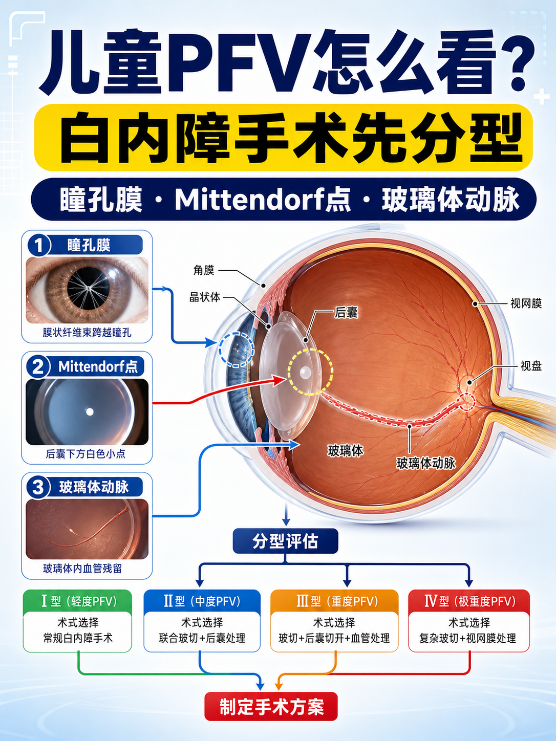 眼科 最新课程：永存胎儿血管（PFV/PHPV）专题课封面